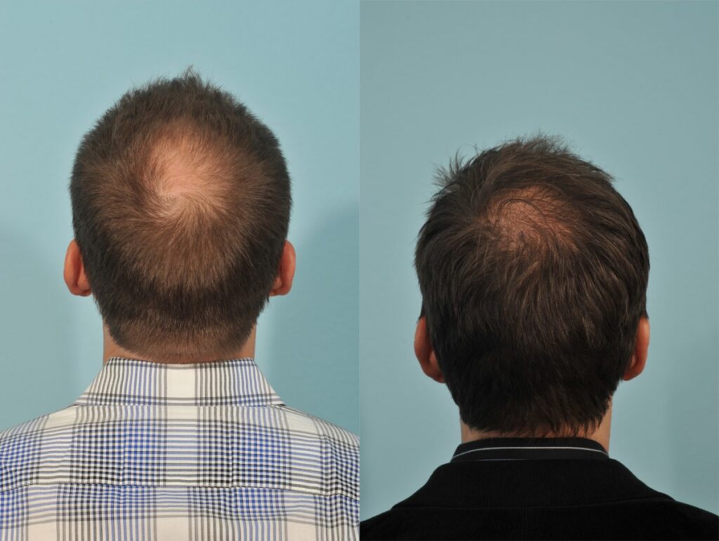 los angeles fue hair transplant clinic
