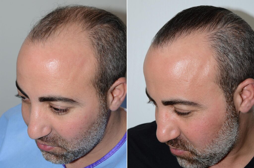 los angeles fue hair transplant clinic
