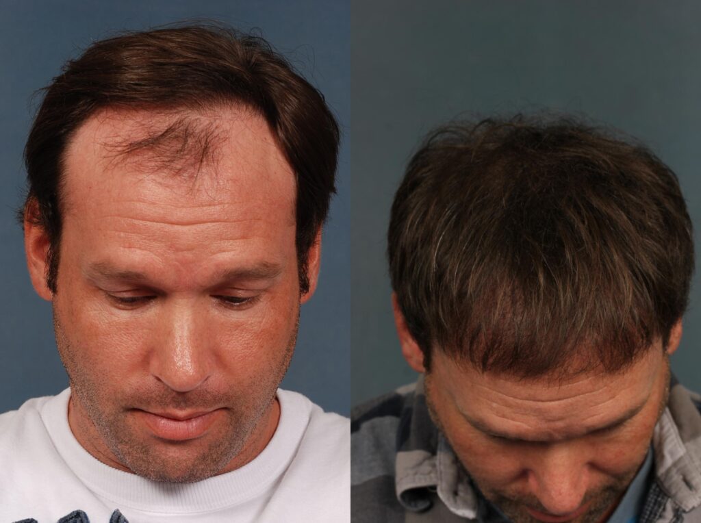 los angeles fue hair transplant clinic